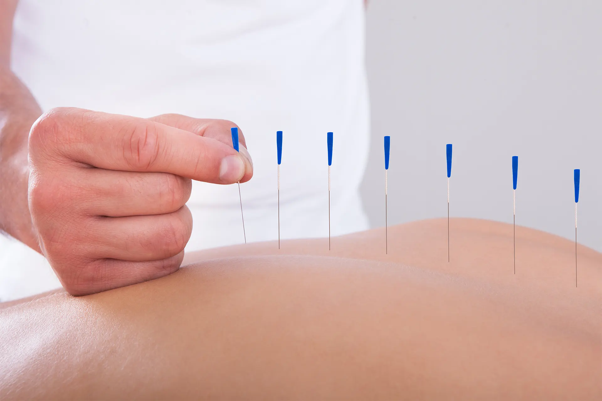 acupuncture to relieve pain instant