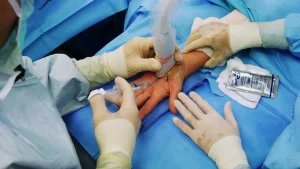 ultrasound guided carpal tunnel release